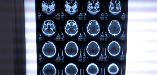 Brain-CT-scan-by-Akira-Ohgaki-702x336